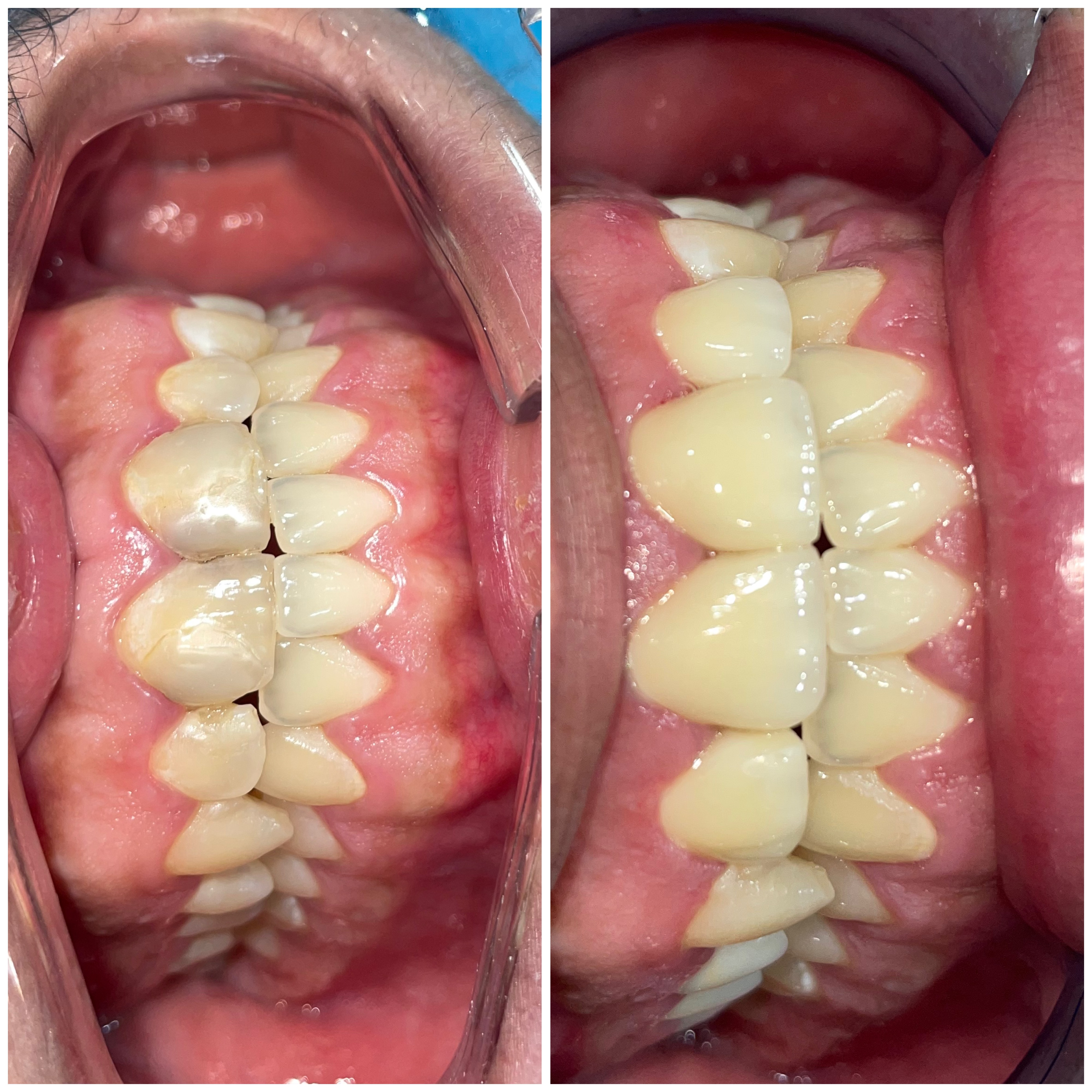 Anterior Veneer Rehabilitation